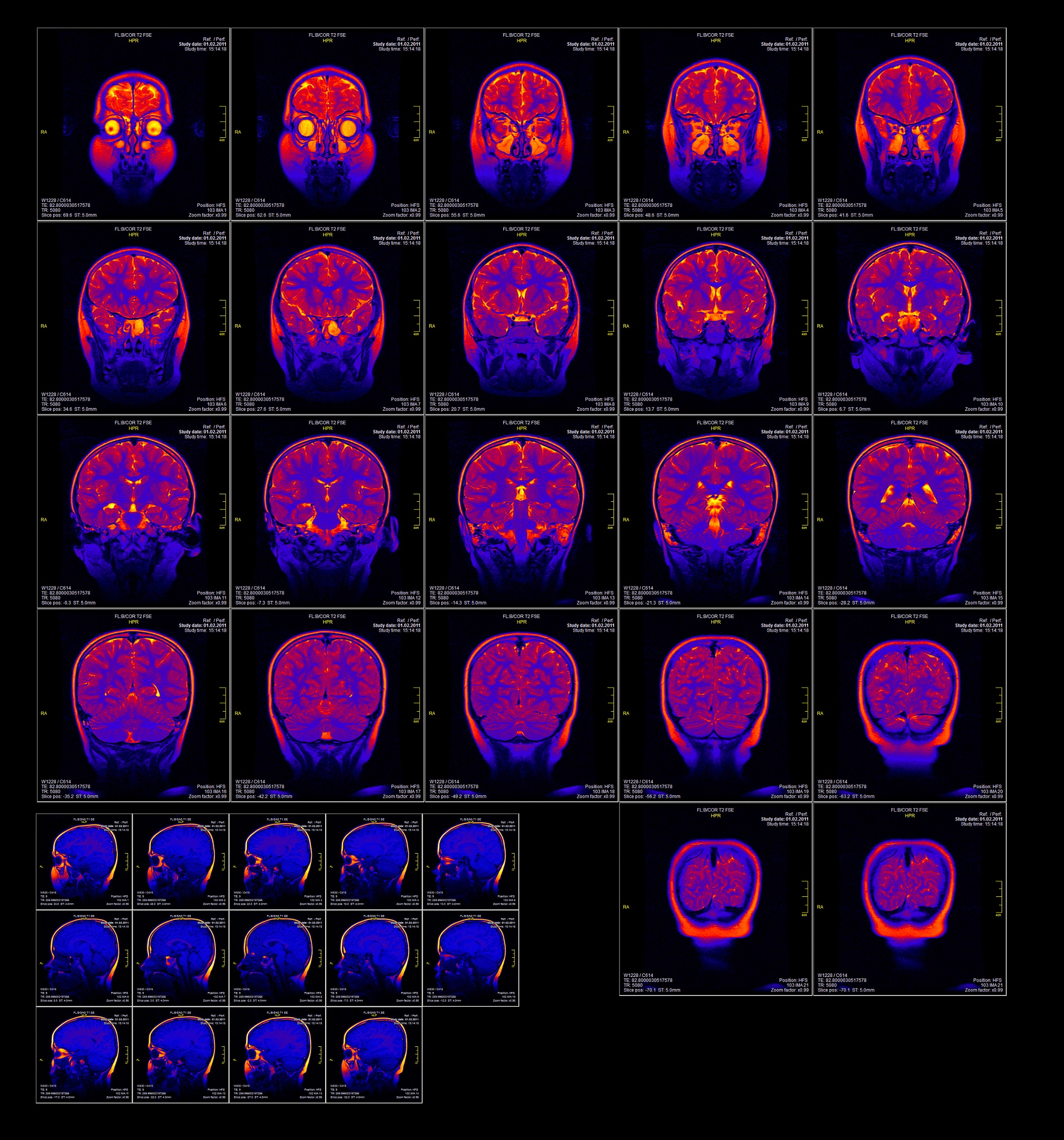 MRI