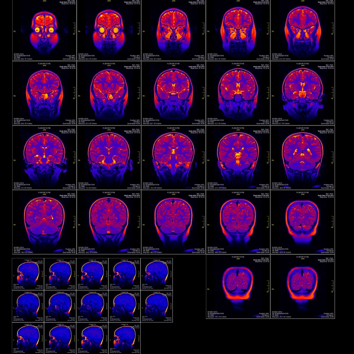 Structural MRI in PTSD