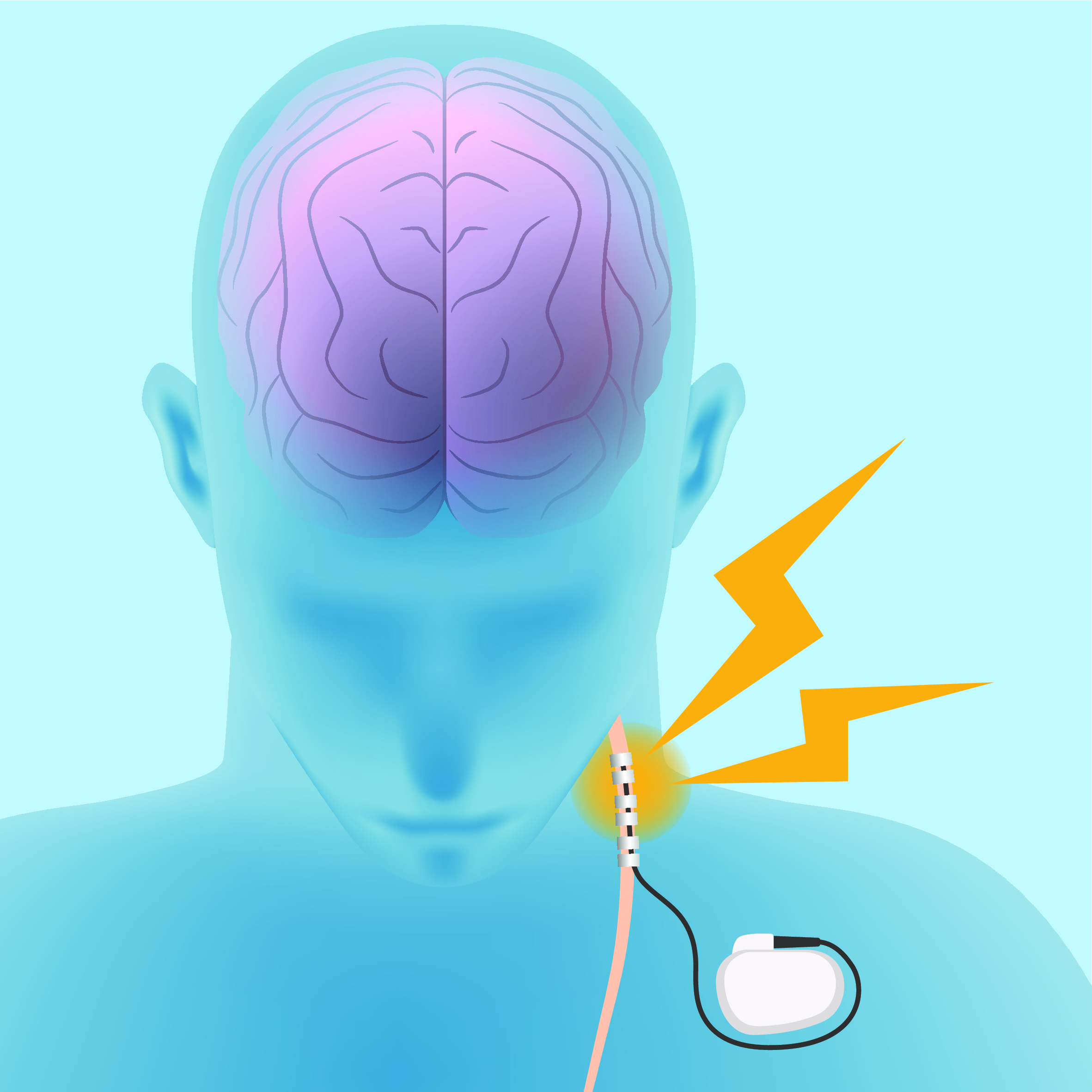 Stimulate The Vagus Nerve Device